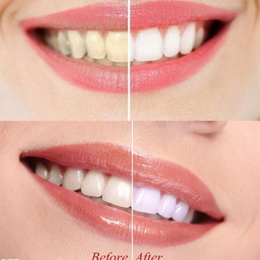 Dientes de carbón de bambú par - Teeth Whitening App reseña y precio