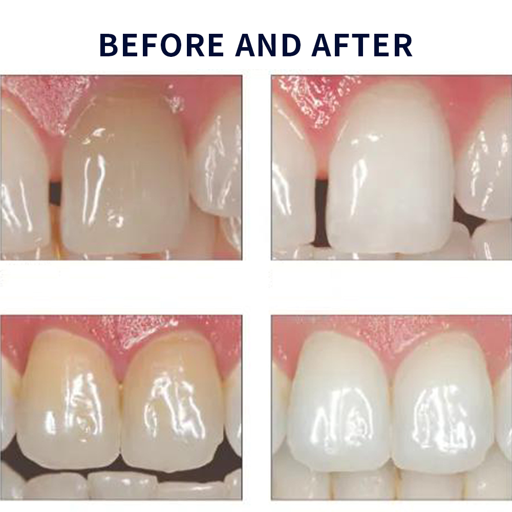 Opalescencia blanqueadora 20%  - Teeth Whitening App reseña y precio