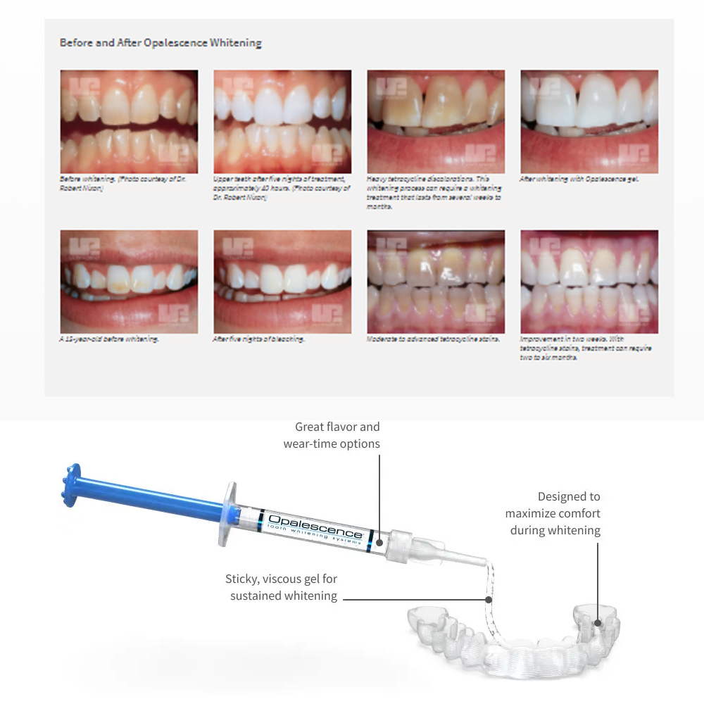 Opalescencia blanqueadora 20%  - Teeth Whitening App reseña y precio