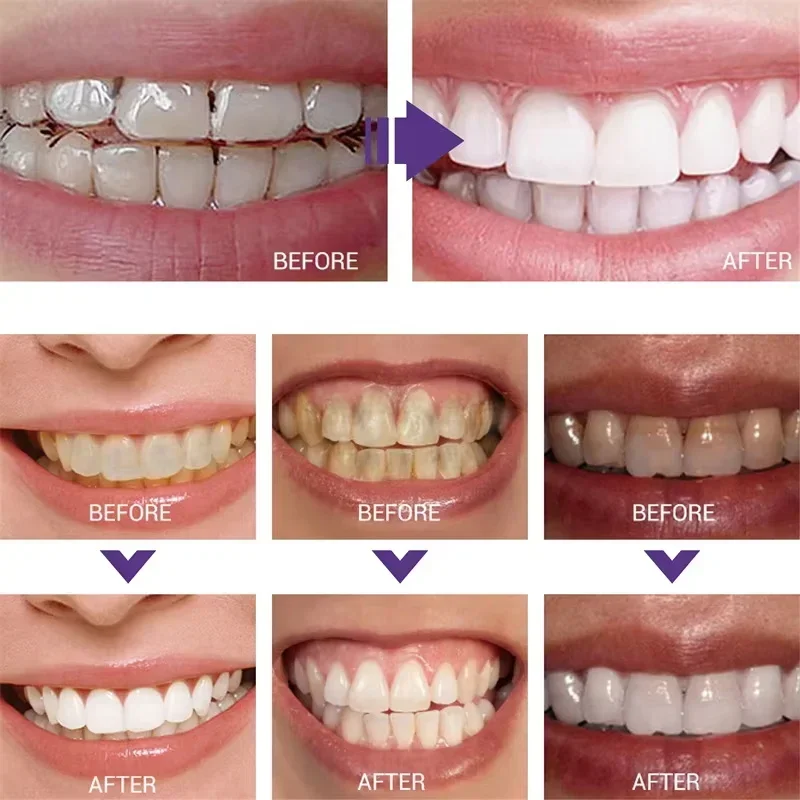Limpieza de dientes, pasta de  - Teeth Whitening Korea reseña y precio