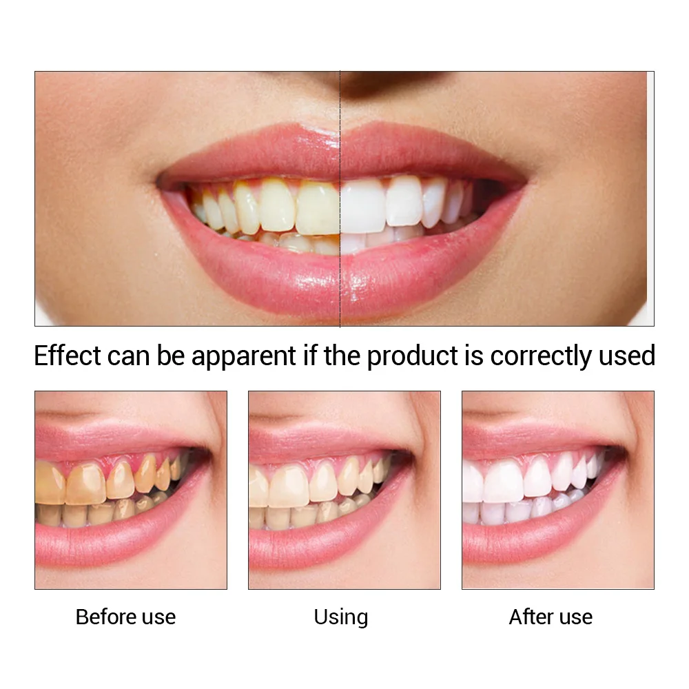 FTEENPLY-esencia para blanquea - Teeth Whitening Best reseña y precio