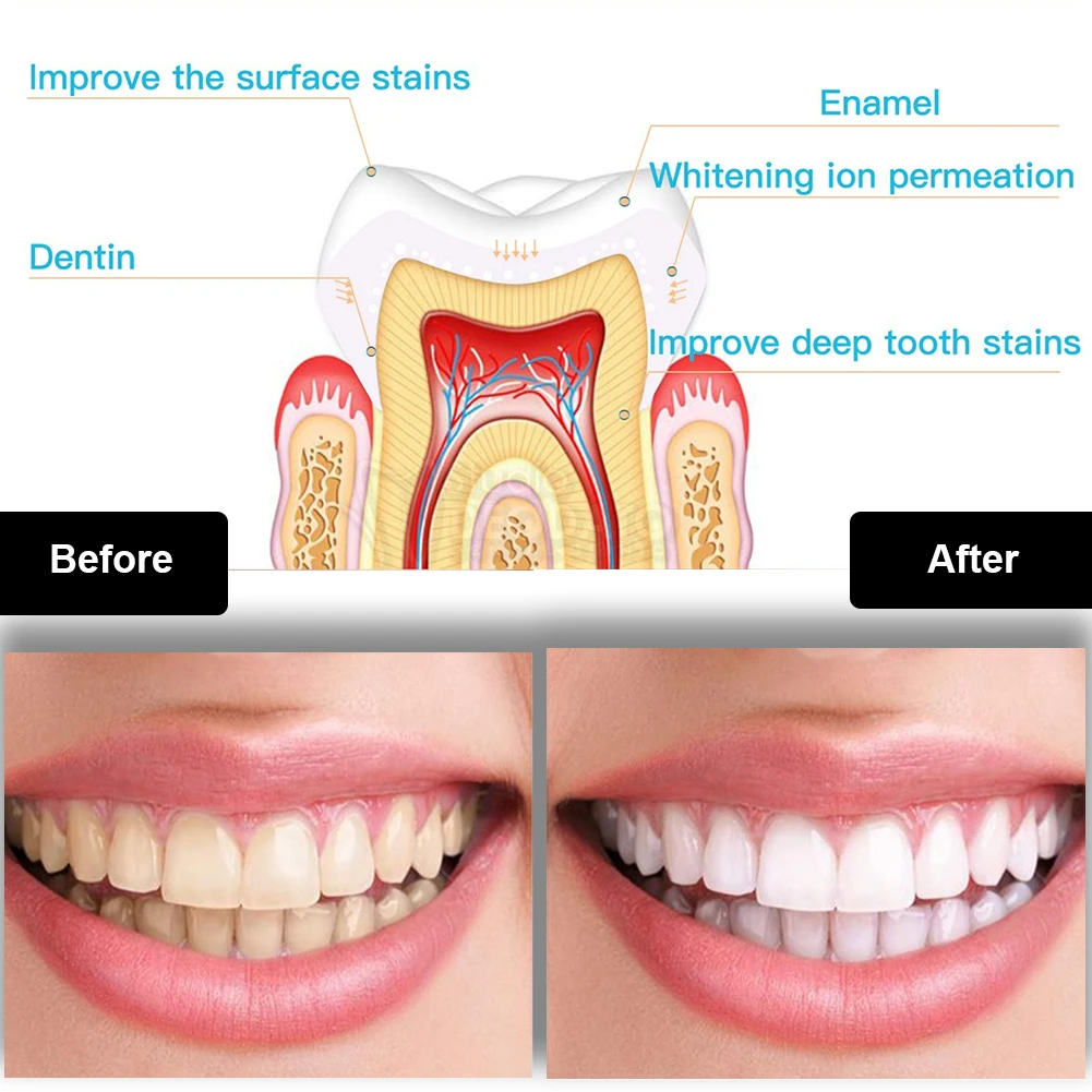 Kit de blanqueamiento Dental M - Teeth Whitening App reseña y precio